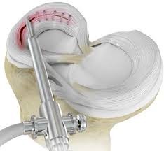 Meniscus Repair